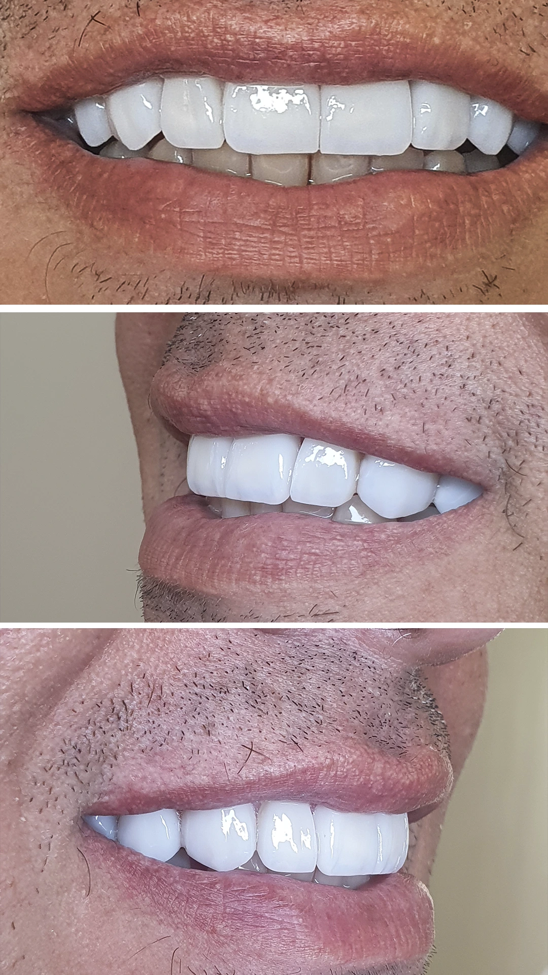 Paciente 6 depois facetas