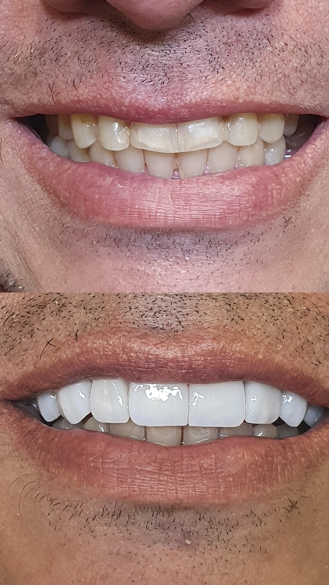 antes e depois paciente 6